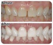 Professional Teeth Whitening Training in Toronto